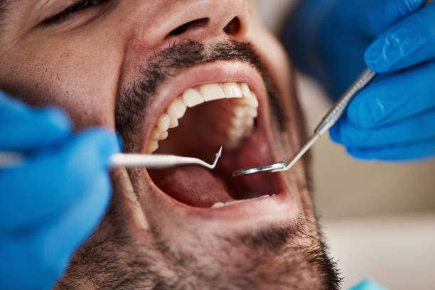 Best Emergency Tooth Extraction in Oxford, MS